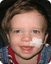 Smiling child with a nasal tube.
